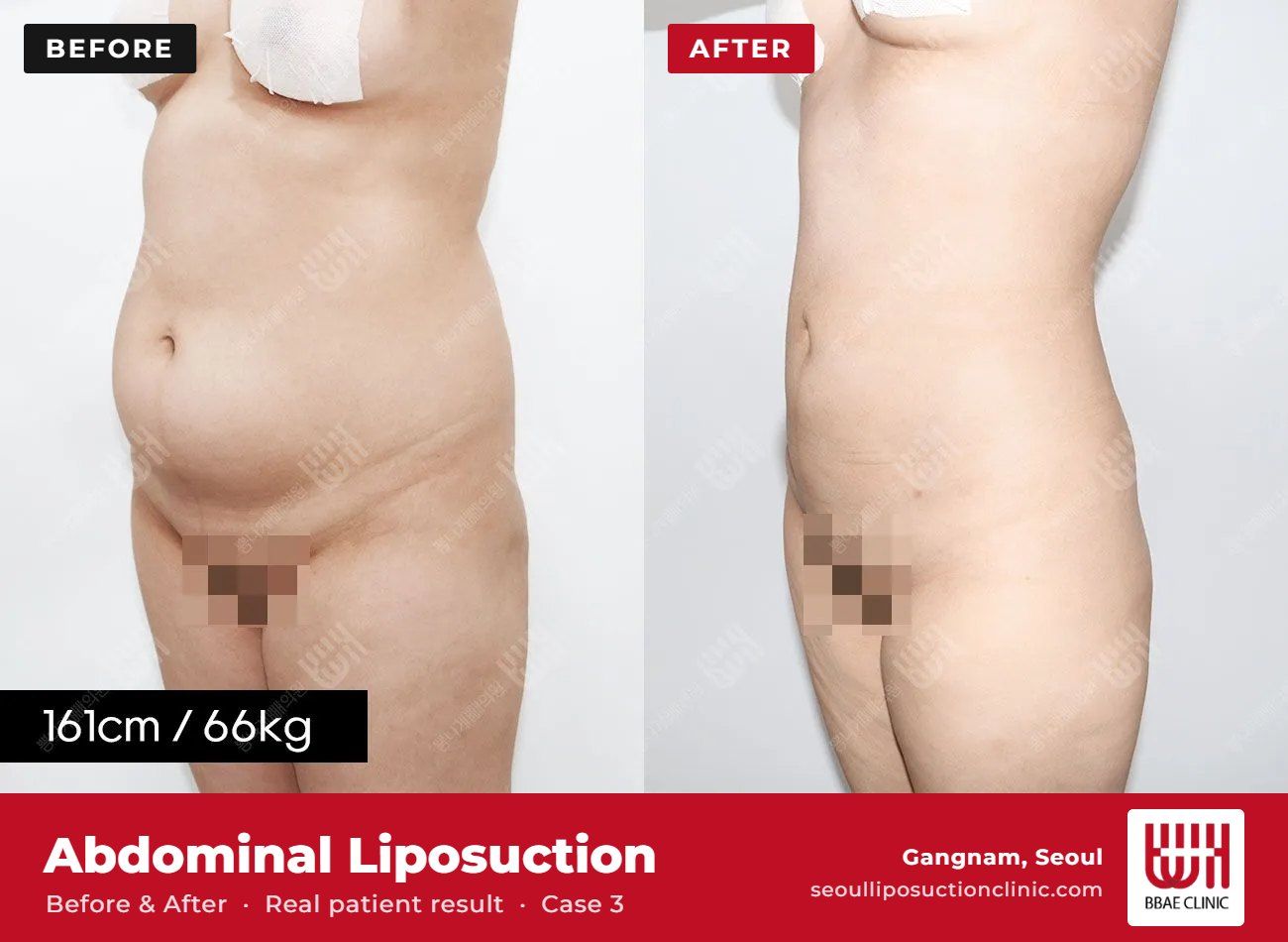Abdominal liposuction before and after, case 3 (photo 2 of 2) – BBAE Clinic, Gangnam Seoul