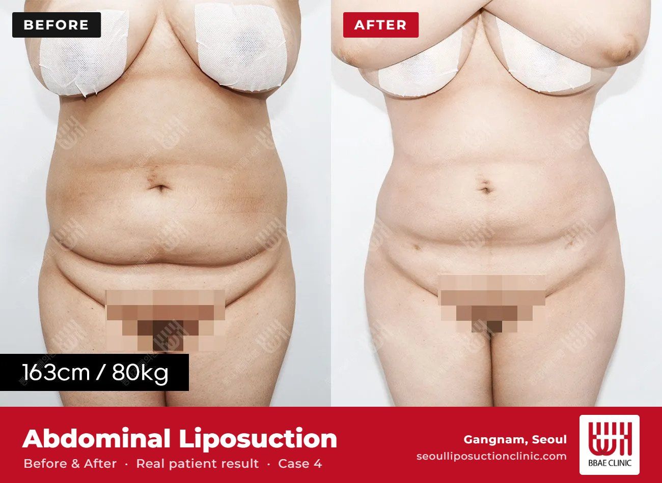 Abdominal liposuction before and after, case 4 (photo 1 of 2) – BBAE Clinic, Gangnam Seoul