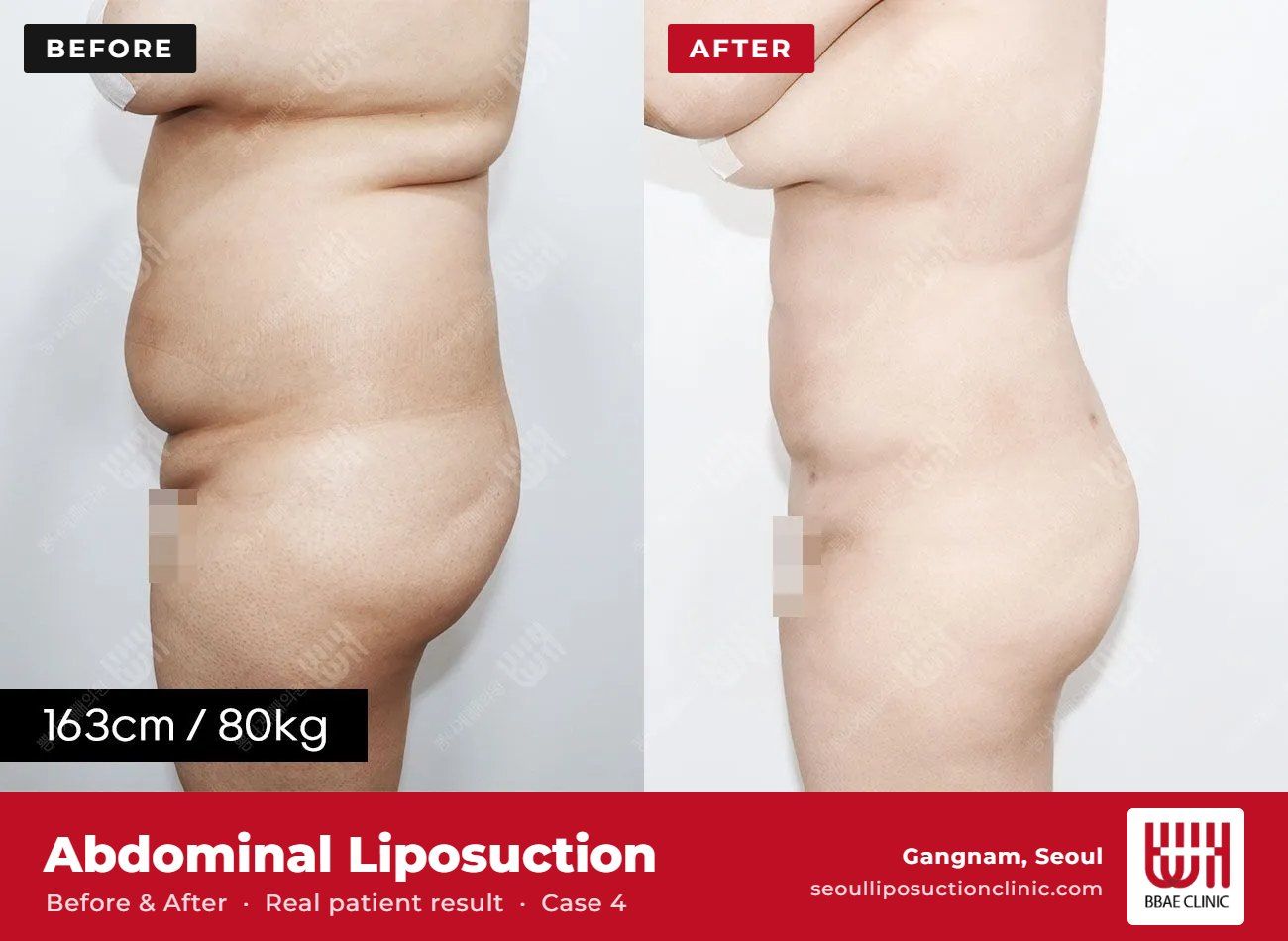 Abdominal liposuction before and after, case 4 (photo 2 of 2) – BBAE Clinic, Gangnam Seoul