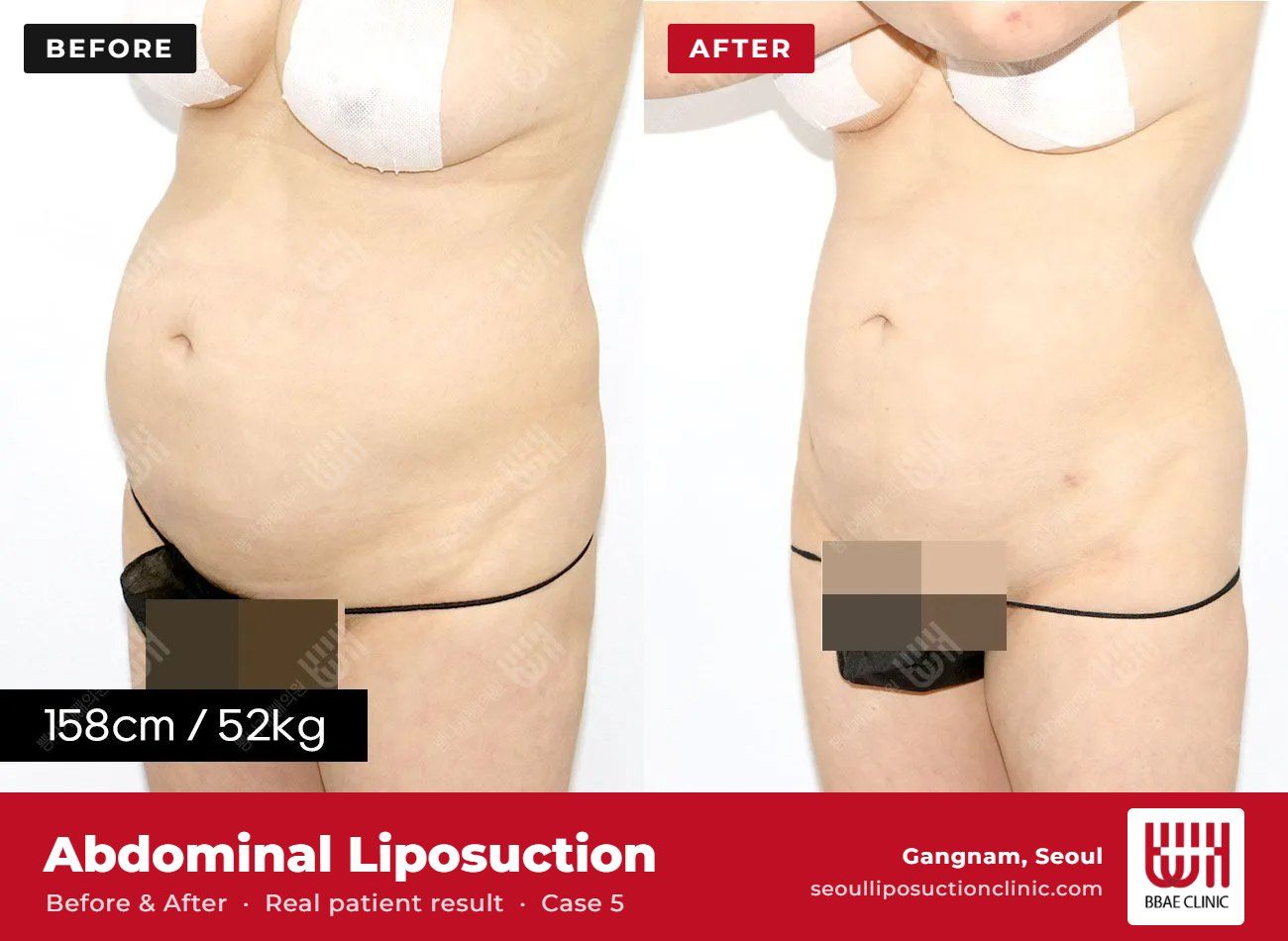 Abdominal liposuction before and after, case 5 (photo 1 of 2) – BBAE Clinic, Gangnam Seoul