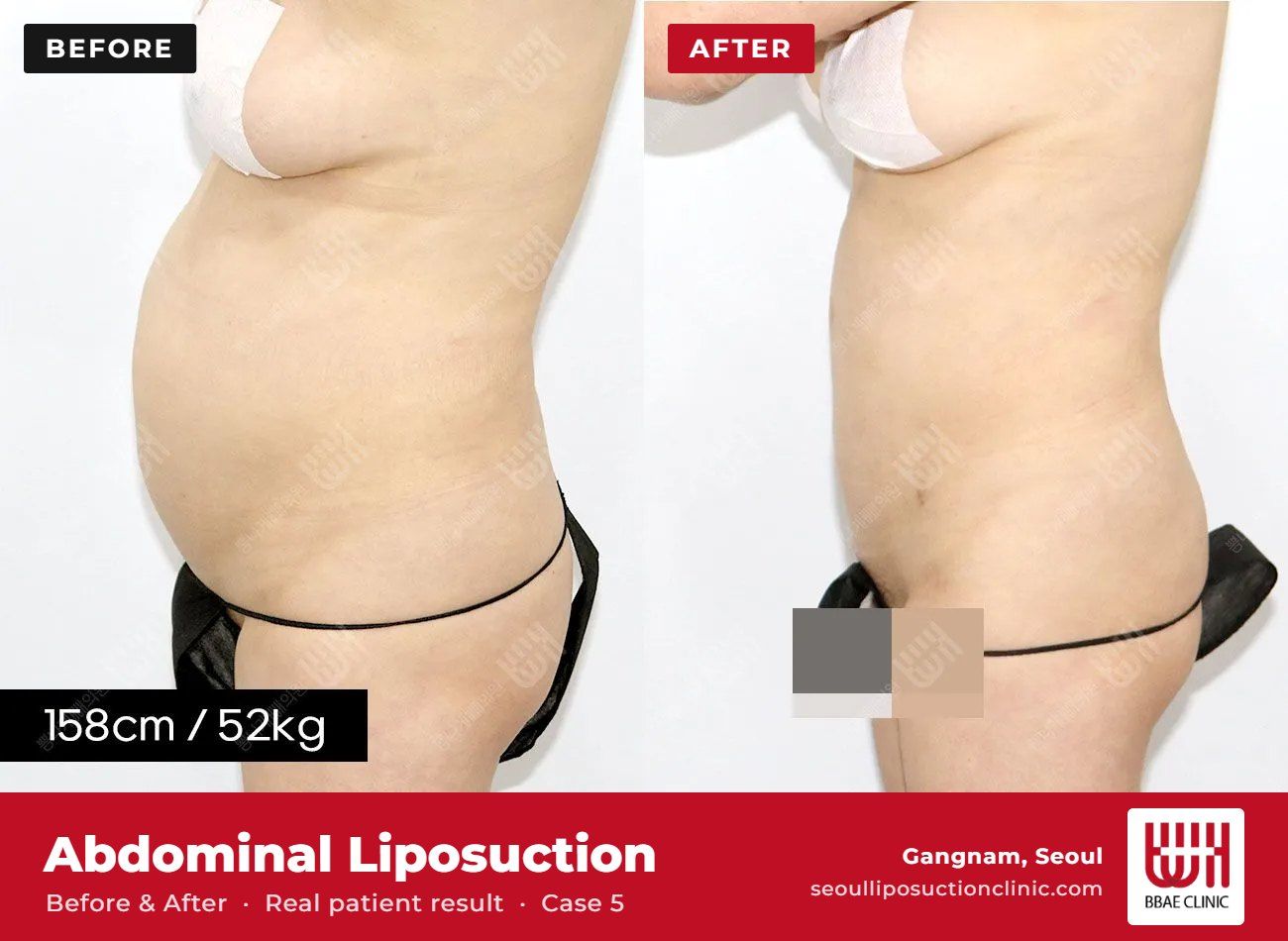 Abdominal liposuction before and after, case 5 (photo 2 of 2) – BBAE Clinic, Gangnam Seoul