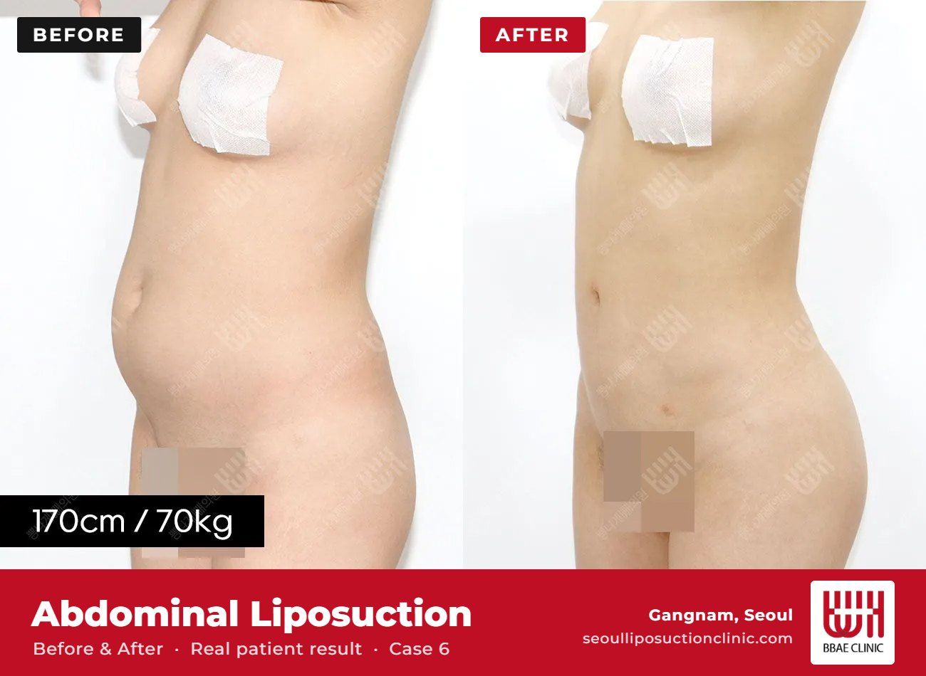 Abdominal liposuction before and after, case 6 (photo 1 of 2) – BBAE Clinic, Gangnam Seoul