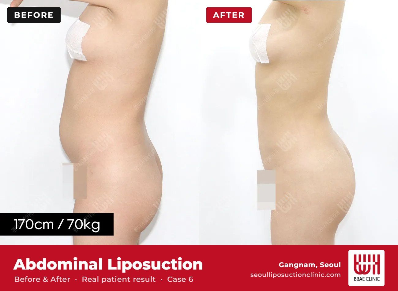 Abdominal liposuction before and after, case 6 (photo 2 of 2) – BBAE Clinic, Gangnam Seoul