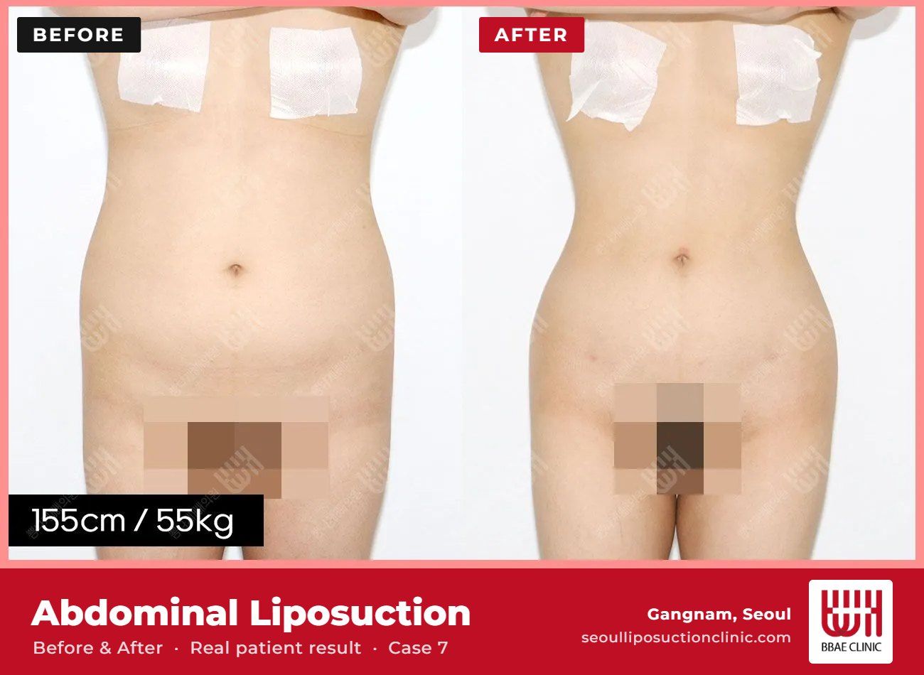 Abdominal liposuction before and after, case 7 (photo 1 of 2) – BBAE Clinic, Gangnam Seoul