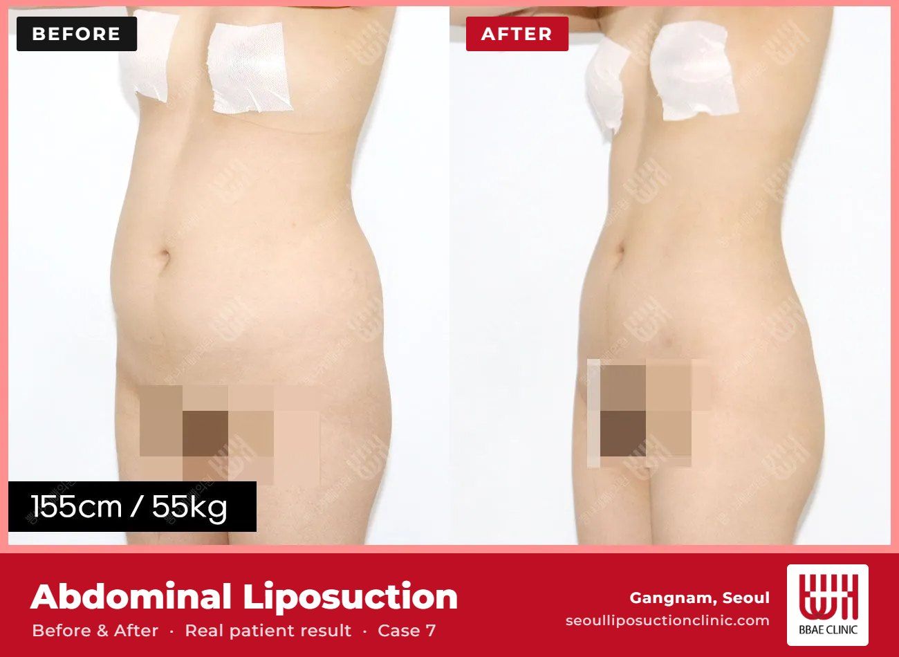 Abdominal liposuction before and after, case 7 (photo 2 of 2) – BBAE Clinic, Gangnam Seoul