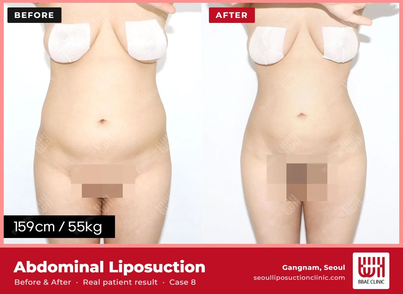 Abdominal liposuction before and after, case 8 (photo 1 of 2) – BBAE Clinic, Gangnam Seoul