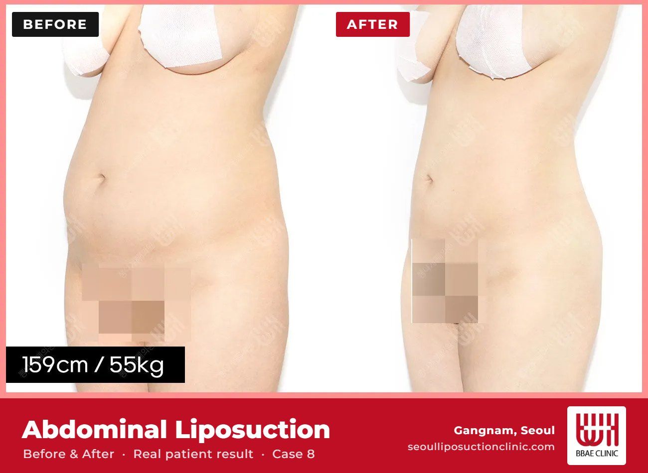 Abdominal liposuction before and after, case 8 (photo 2 of 2) – BBAE Clinic, Gangnam Seoul