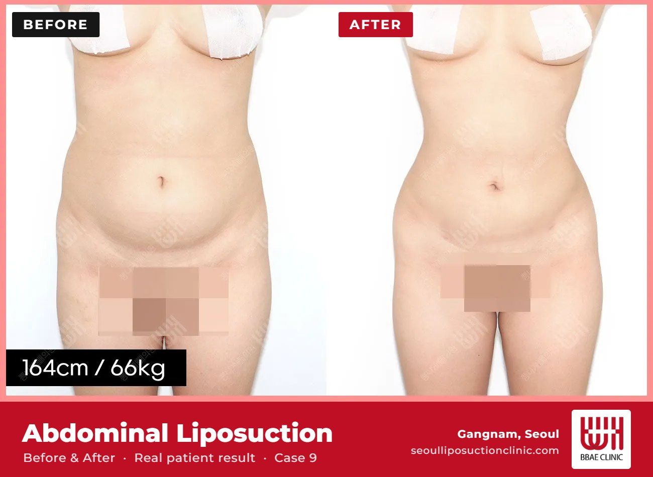 Abdominal liposuction before and after, case 9 (photo 1 of 2) – BBAE Clinic, Gangnam Seoul
