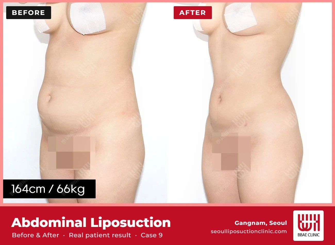 Abdominal liposuction before and after, case 9 (photo 2 of 2) – BBAE Clinic, Gangnam Seoul