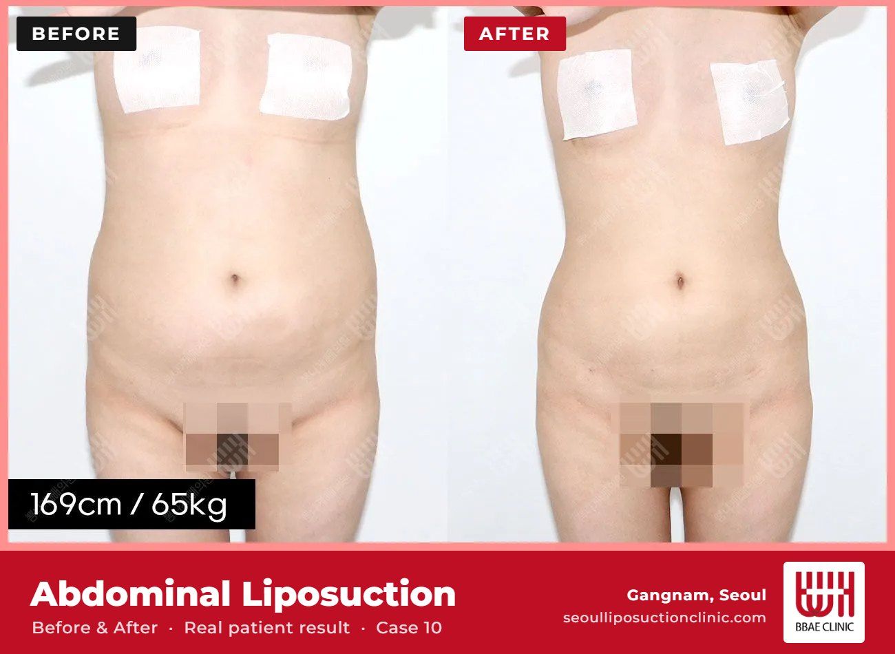 Abdominal liposuction before and after, case 10 (photo 1 of 2) – BBAE Clinic, Gangnam Seoul