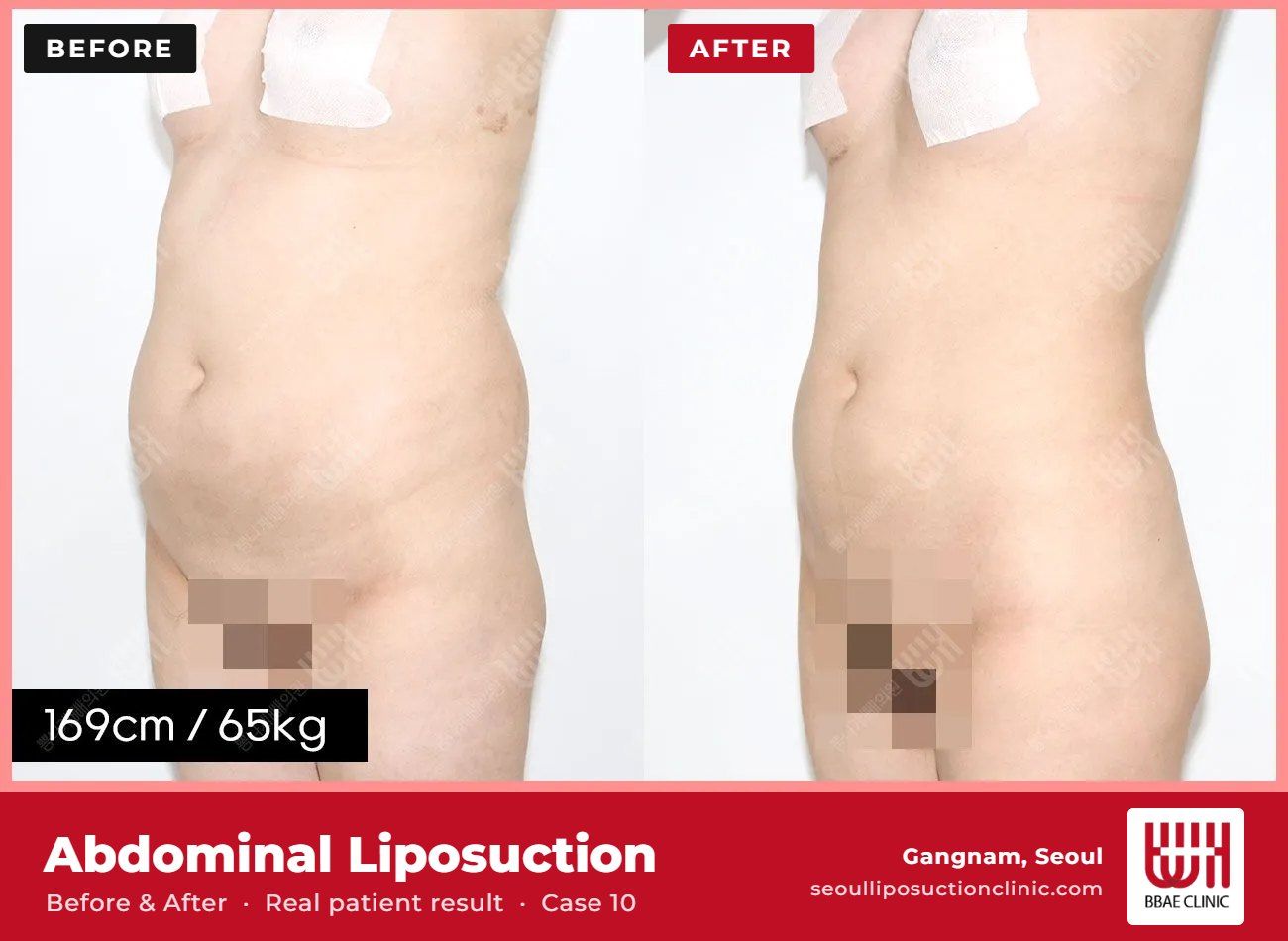 Abdominal liposuction before and after, case 10 (photo 2 of 2) – BBAE Clinic, Gangnam Seoul