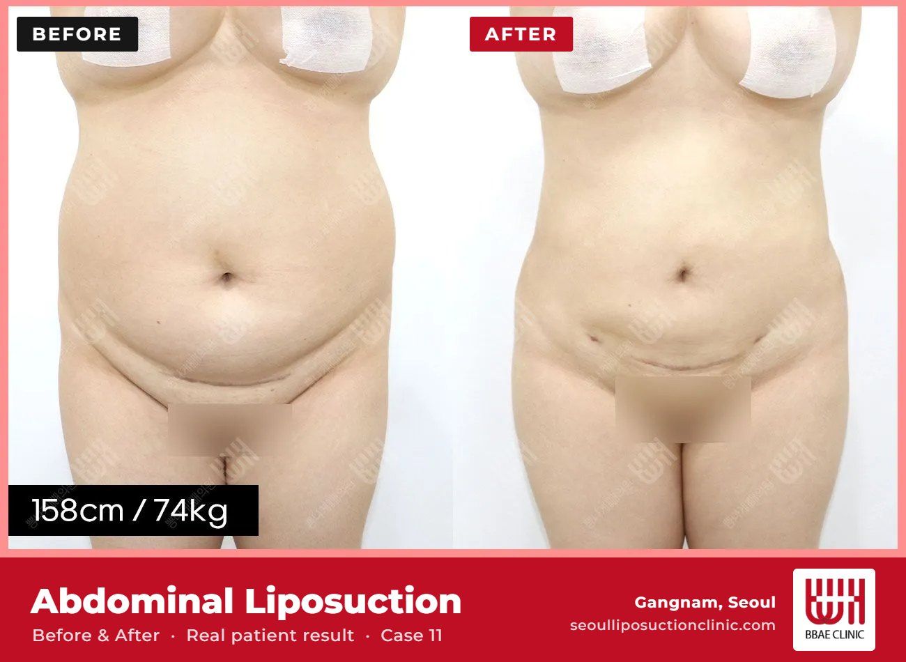 Abdominal liposuction before and after, case 11 (photo 1 of 2) – BBAE Clinic, Gangnam Seoul