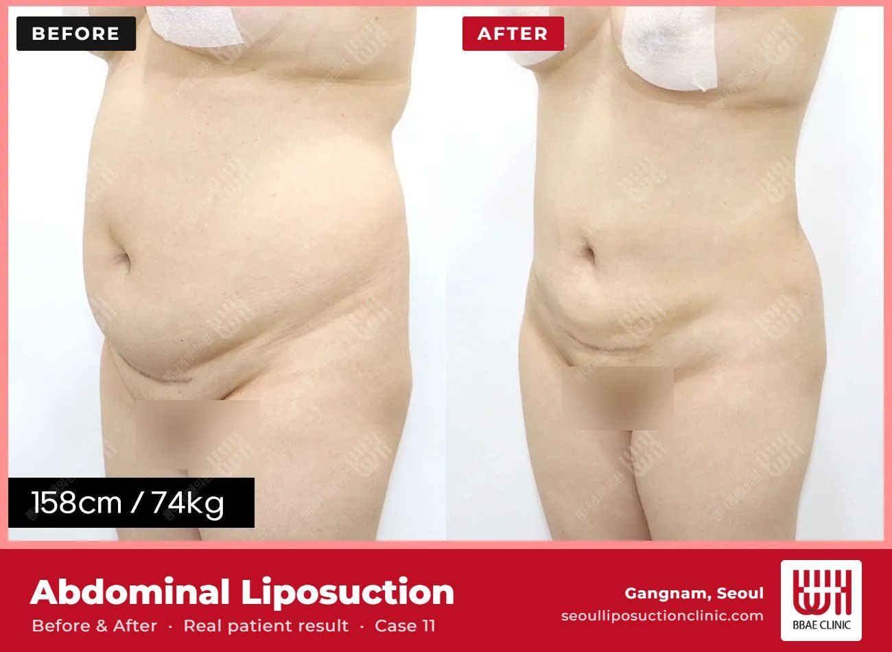 Abdominal liposuction before and after, case 11 (photo 2 of 2) – BBAE Clinic, Gangnam Seoul