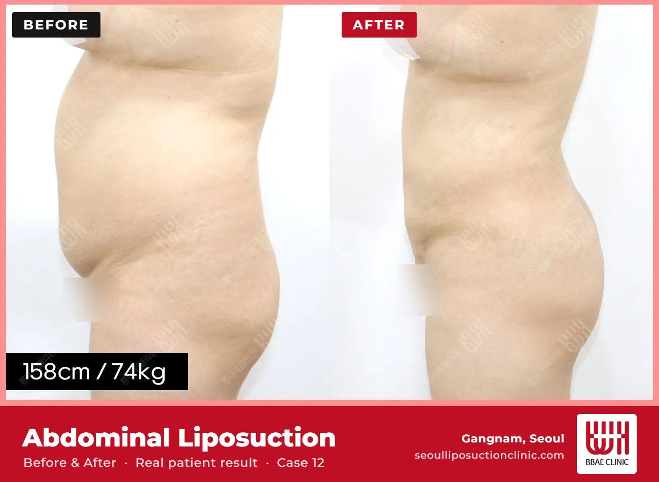 Abdominal liposuction before and after, case 12 (photo 1 of 2) – BBAE Clinic, Gangnam Seoul