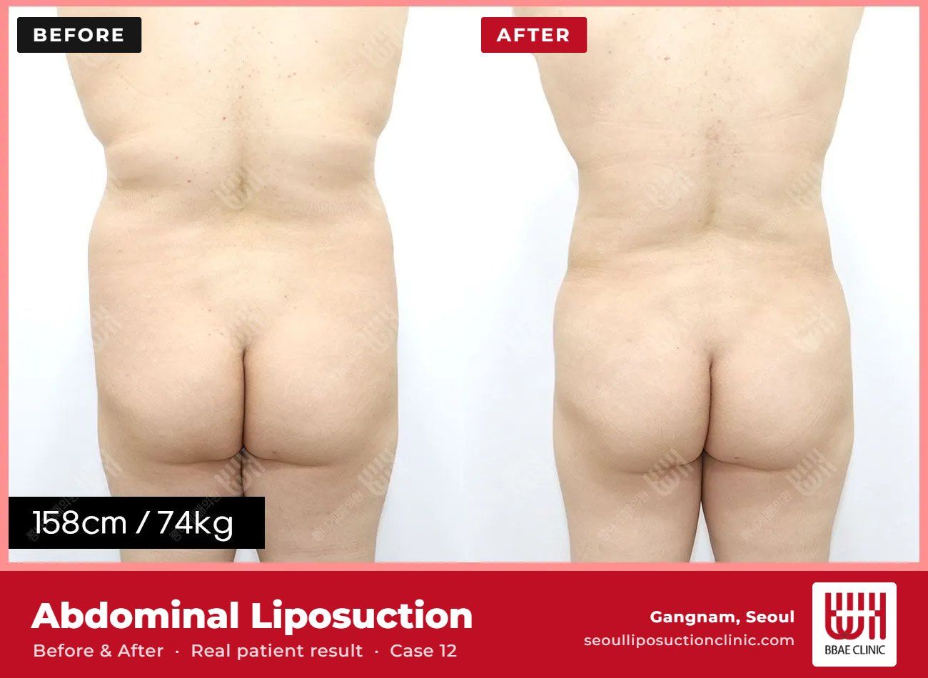 Abdominal liposuction before and after, case 12 (photo 2 of 2) – BBAE Clinic, Gangnam Seoul