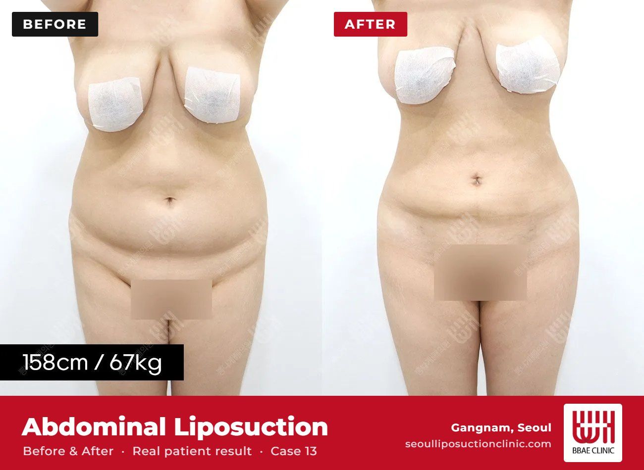 Abdominal liposuction before and after, case 13 (photo 1 of 2) – BBAE Clinic, Gangnam Seoul