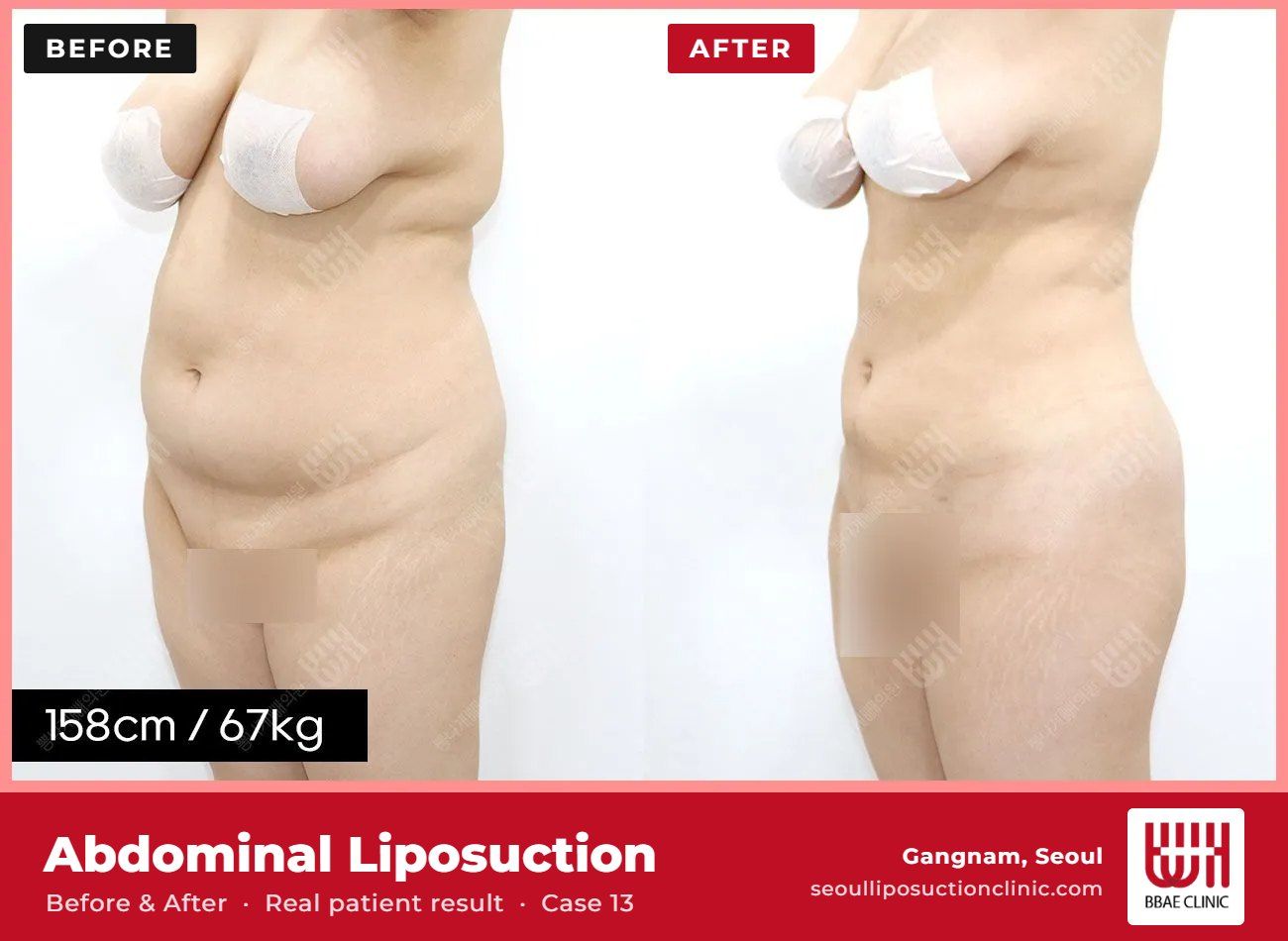 Abdominal liposuction before and after, case 13 (photo 2 of 2) – BBAE Clinic, Gangnam Seoul