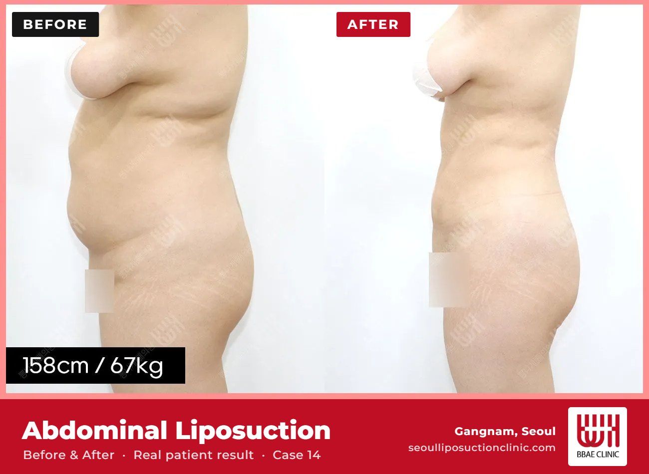 Abdominal liposuction before and after, case 14 (photo 1 of 2) – BBAE Clinic, Gangnam Seoul