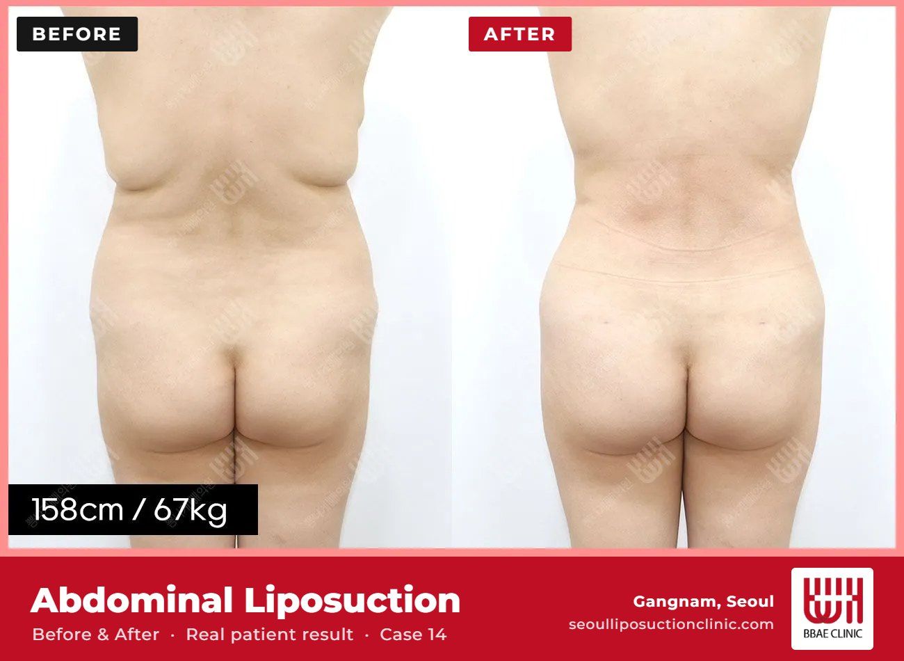 Abdominal liposuction before and after, case 14 (photo 2 of 2) – BBAE Clinic, Gangnam Seoul
