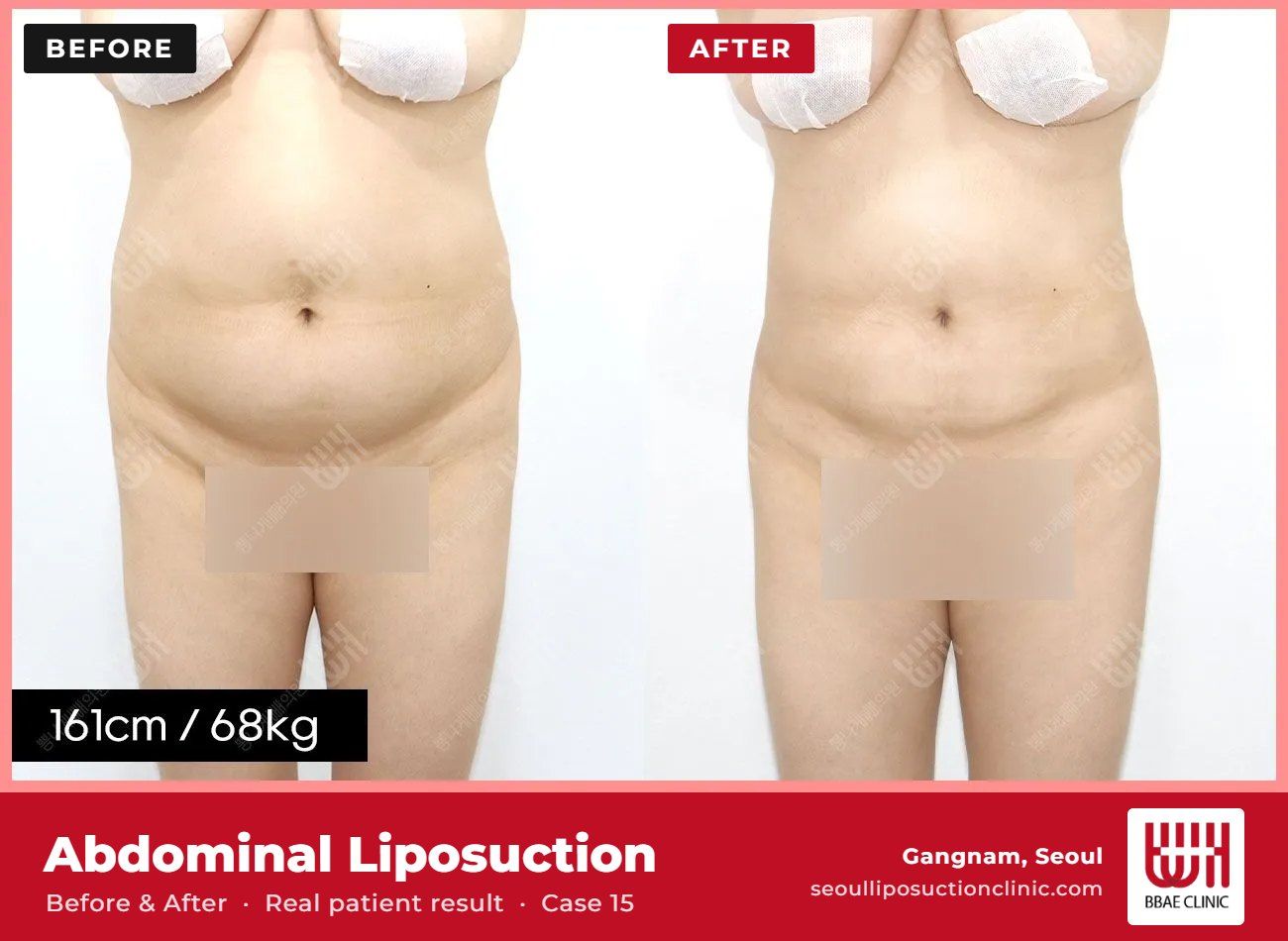 Abdominal liposuction before and after, case 15 (photo 1 of 2) – BBAE Clinic, Gangnam Seoul