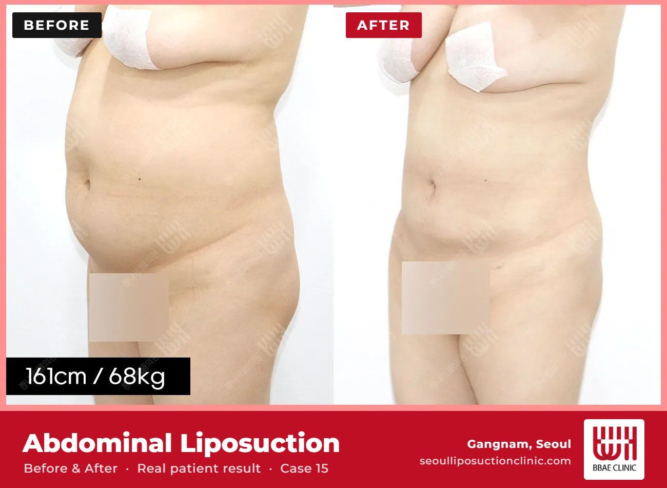 Abdominal liposuction before and after, case 15 (photo 2 of 2) – BBAE Clinic, Gangnam Seoul