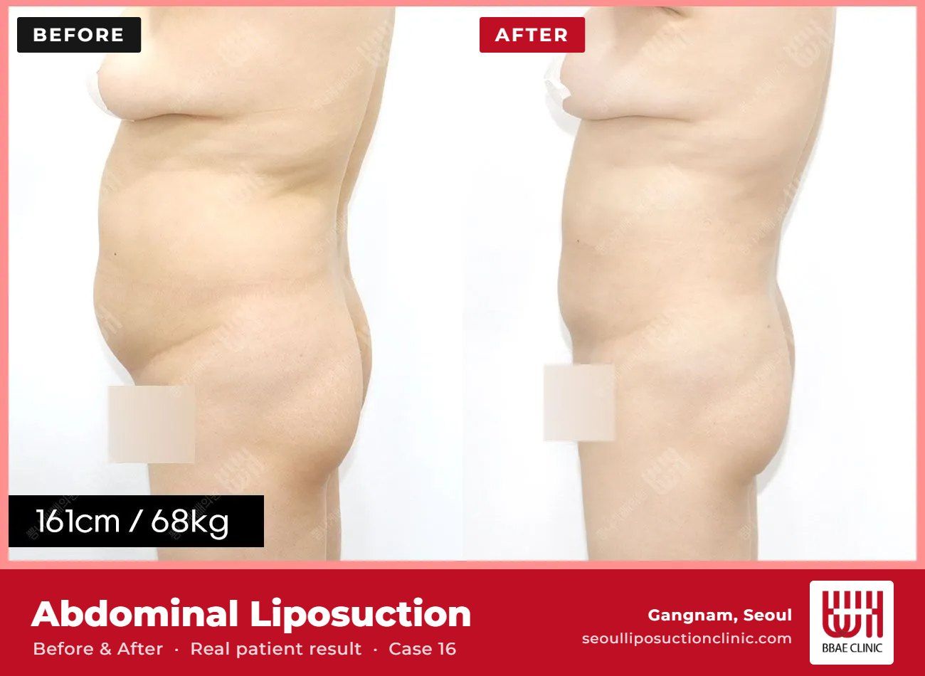 Abdominal liposuction before and after, case 16 (photo 1 of 2) – BBAE Clinic, Gangnam Seoul