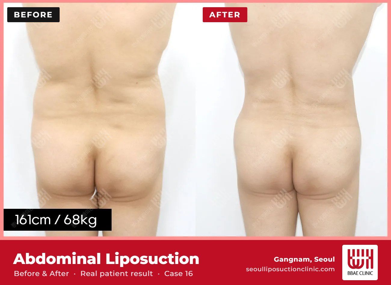 Abdominal liposuction before and after, case 16 (photo 2 of 2) – BBAE Clinic, Gangnam Seoul