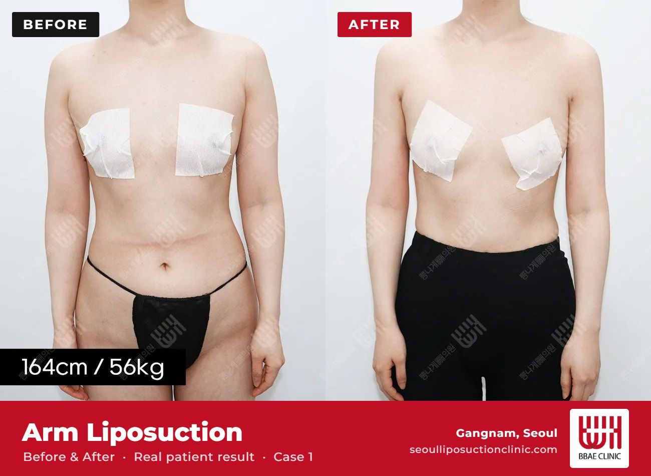Arm liposuction before and after, case 1 (photo 1 of 2) – BBAE Clinic, Gangnam Seoul