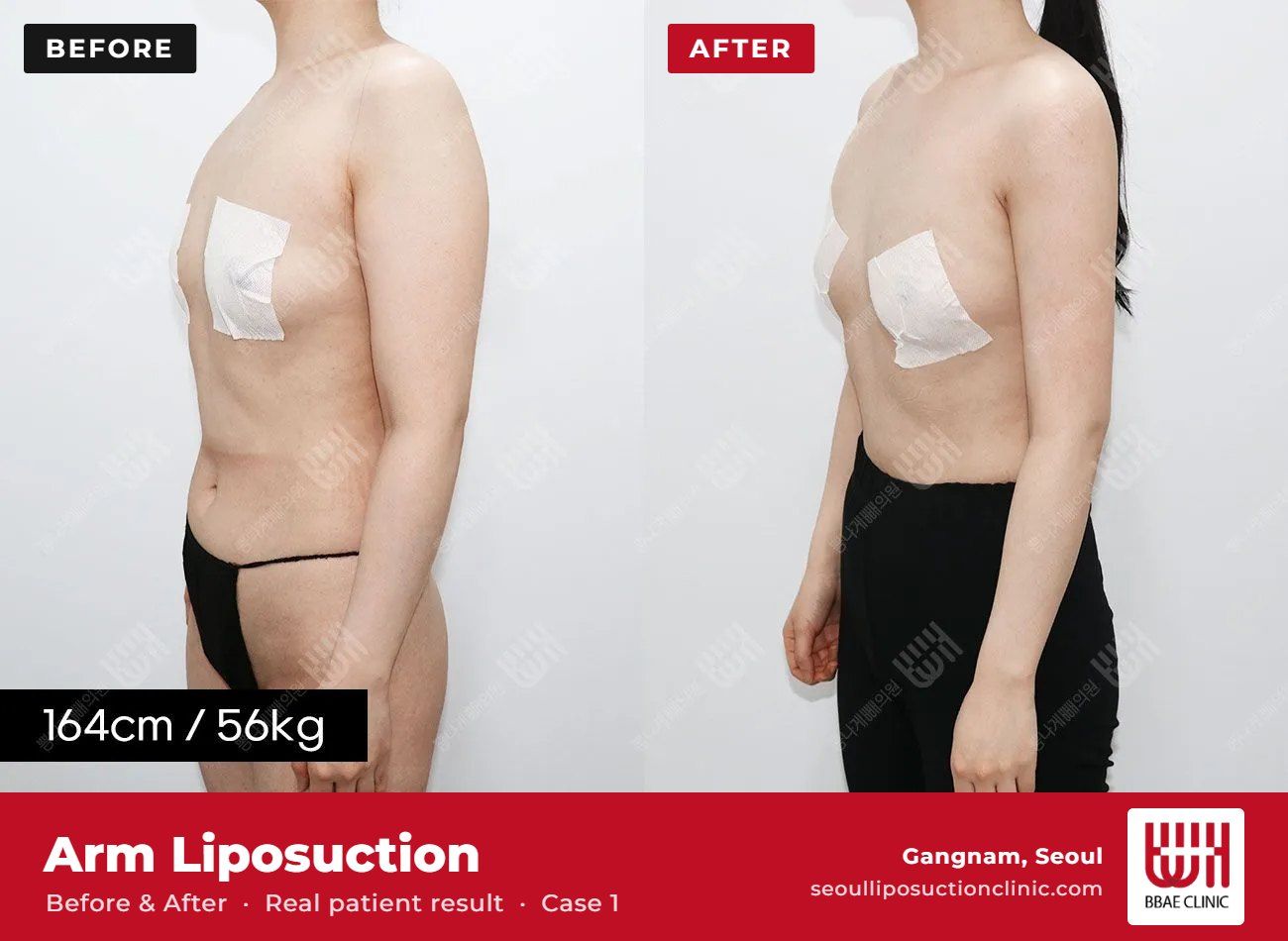 Arm liposuction before and after, case 1 (photo 2 of 2) – BBAE Clinic, Gangnam Seoul