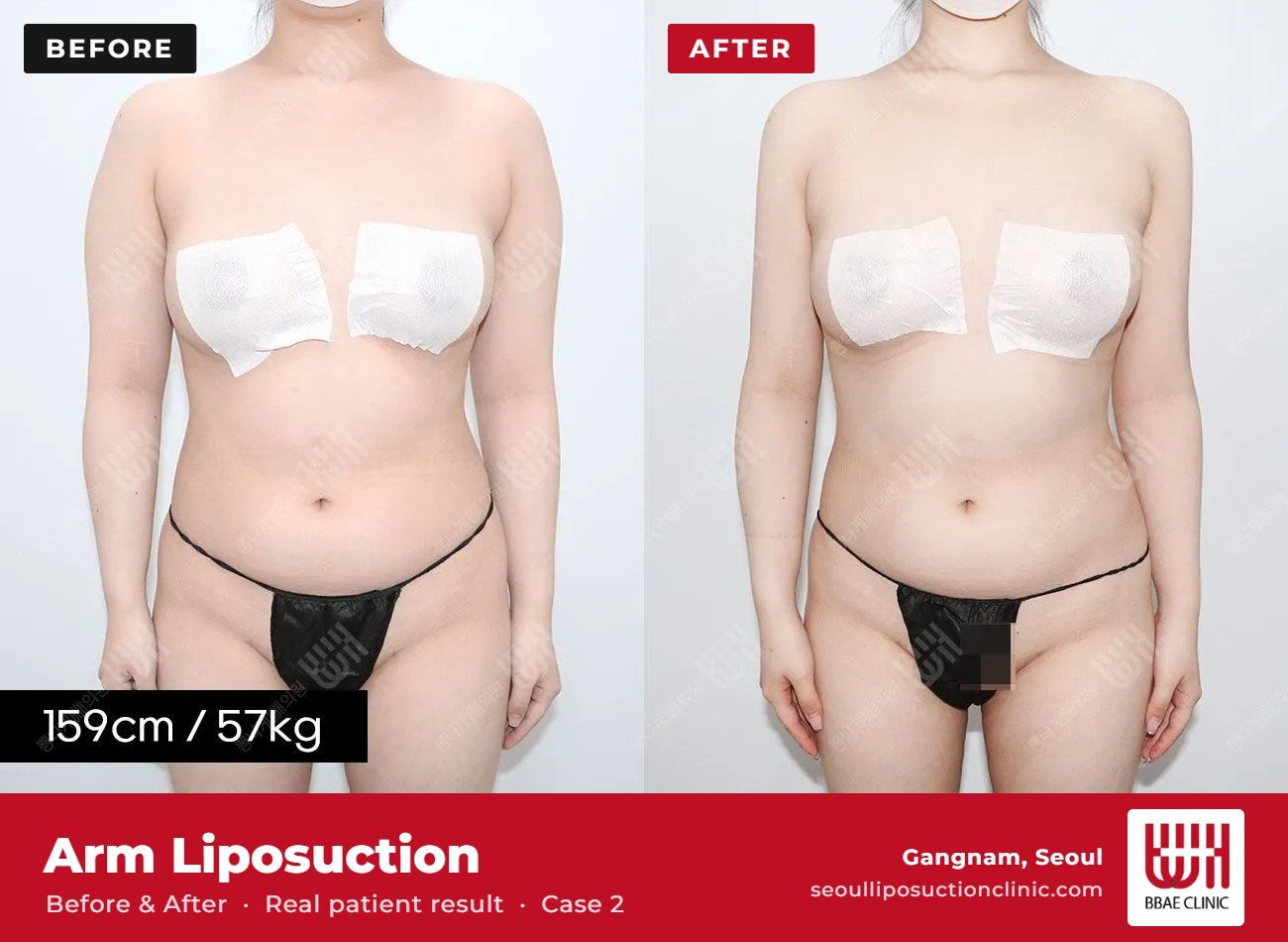 Arm liposuction before and after, case 2 (photo 1 of 2) – BBAE Clinic, Gangnam Seoul