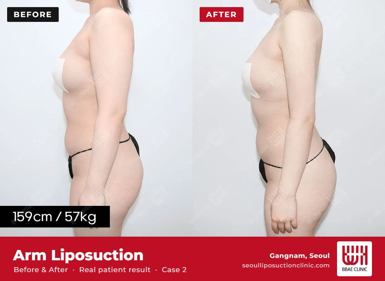 Arm liposuction before and after, case 2 (photo 2 of 2) – BBAE Clinic, Gangnam Seoul