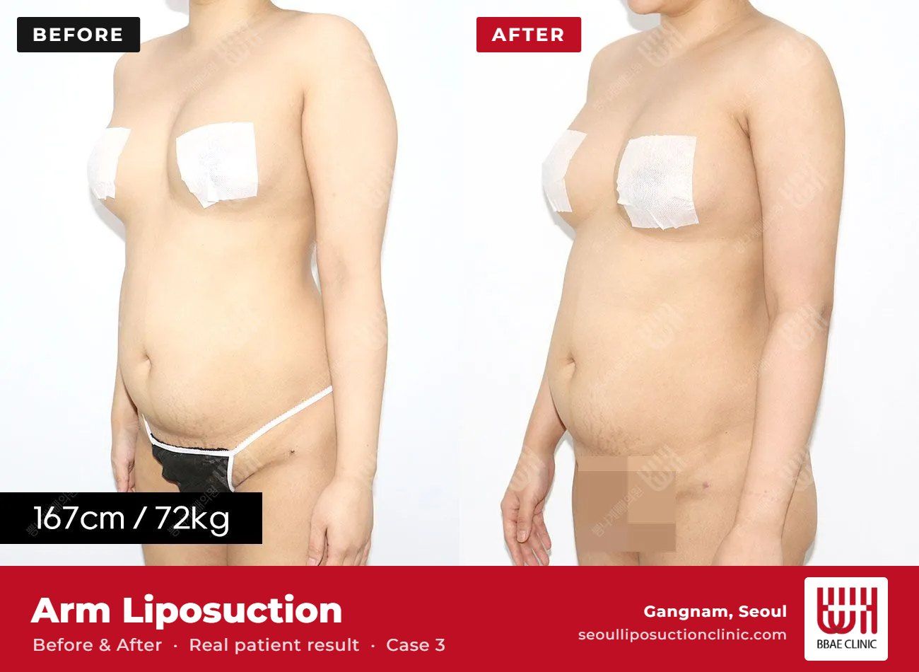 Arm liposuction before and after, case 3 (photo 1 of 2) – BBAE Clinic, Gangnam Seoul