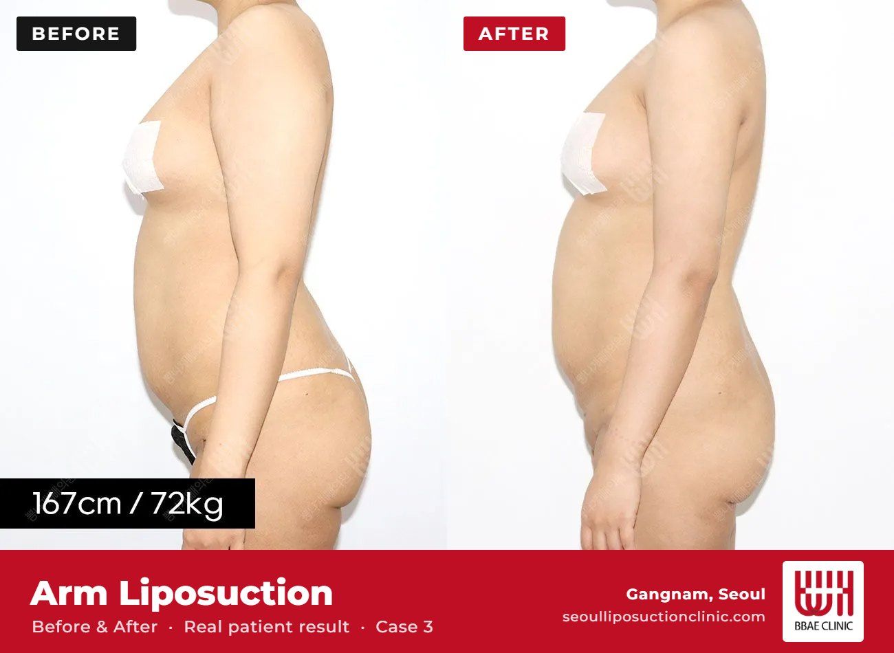 Arm liposuction before and after, case 3 (photo 2 of 2) – BBAE Clinic, Gangnam Seoul