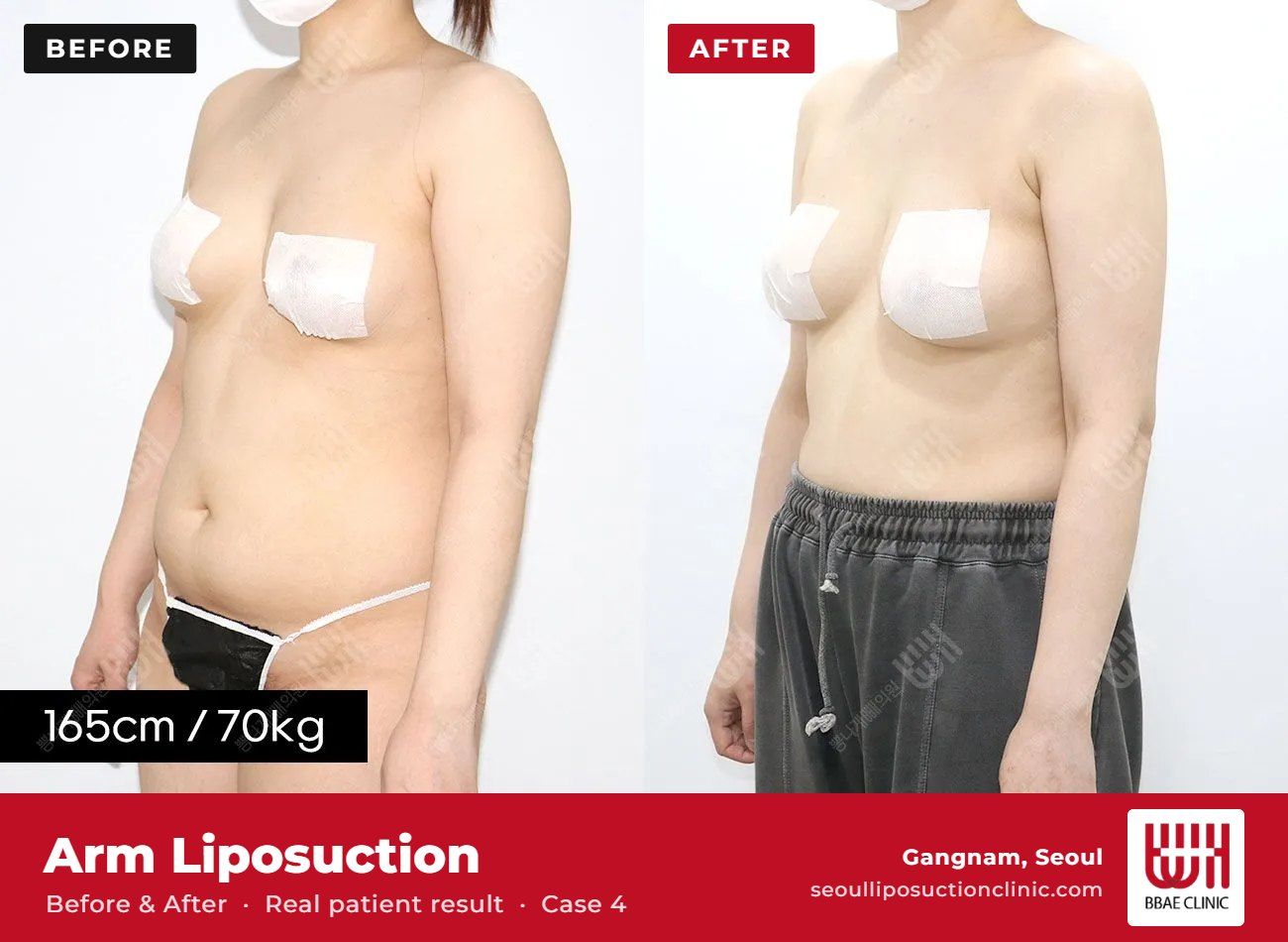 Arm liposuction before and after, case 4 (photo 1 of 2) – BBAE Clinic, Gangnam Seoul