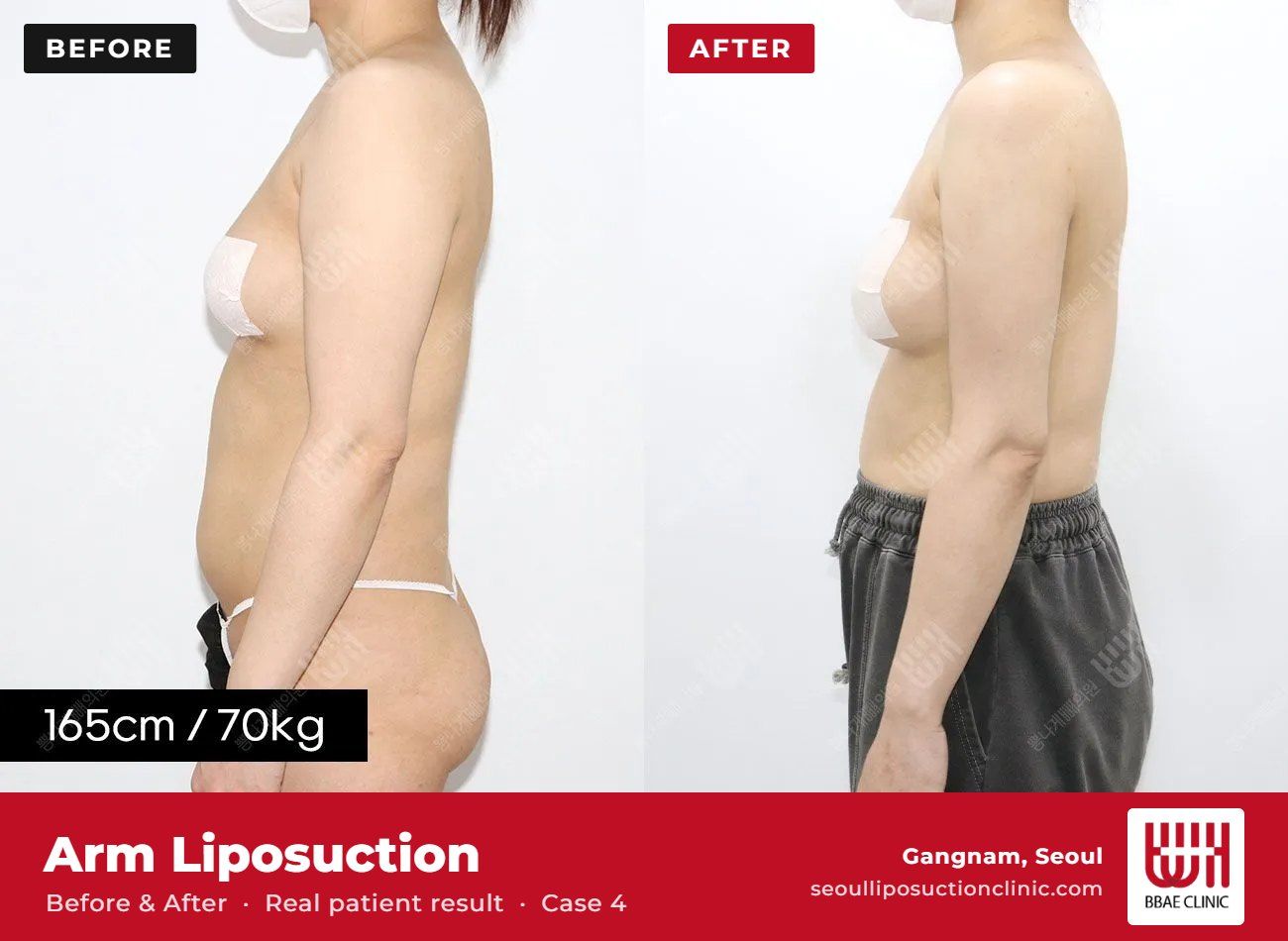 Arm liposuction before and after, case 4 (photo 2 of 2) – BBAE Clinic, Gangnam Seoul