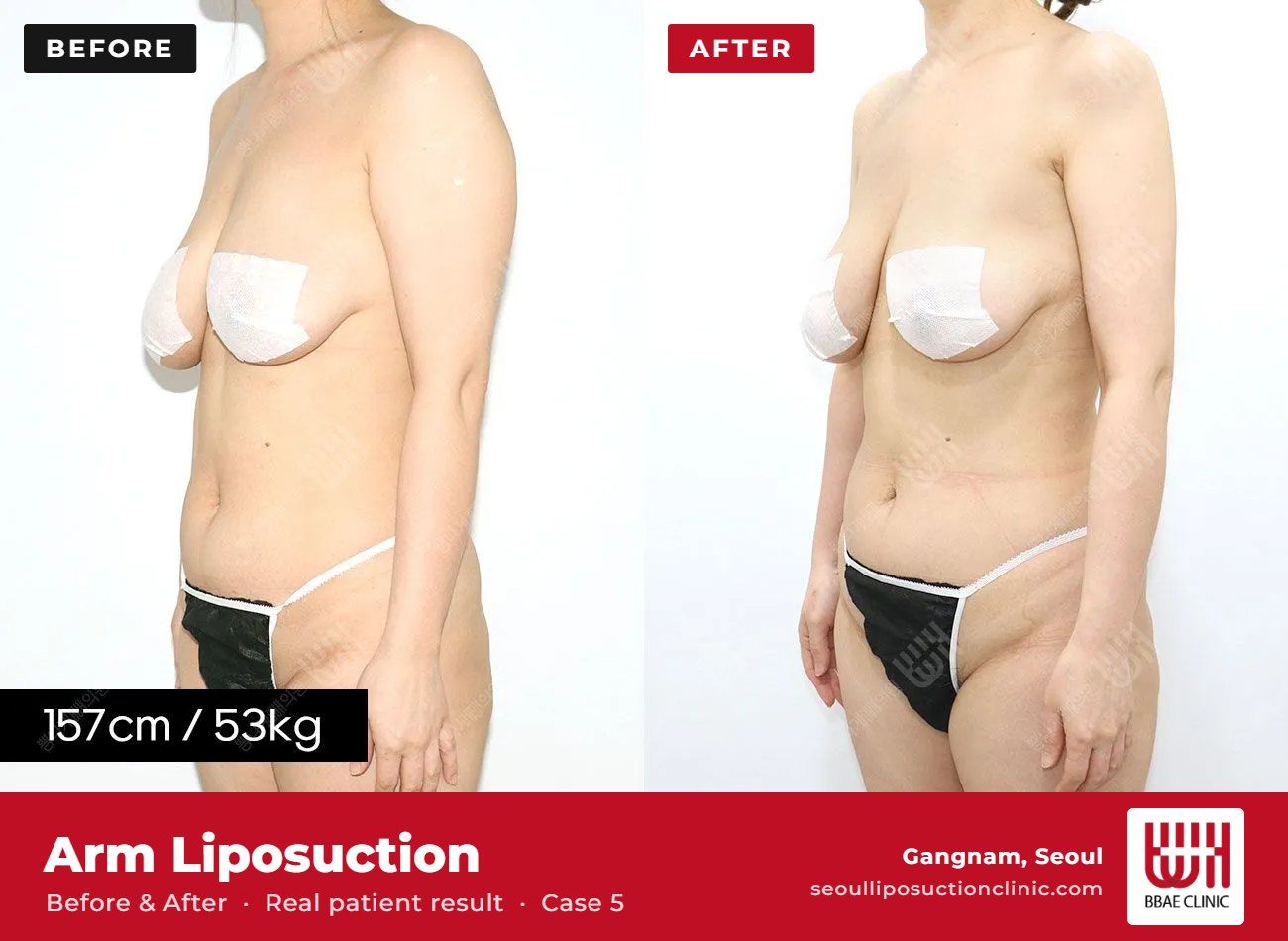 Arm liposuction before and after, case 5 (photo 1 of 2) – BBAE Clinic, Gangnam Seoul