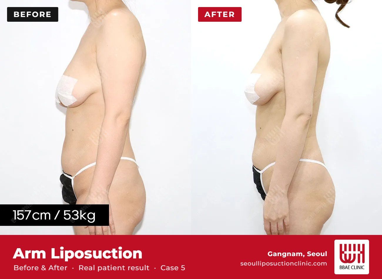 Arm liposuction before and after, case 5 (photo 2 of 2) – BBAE Clinic, Gangnam Seoul