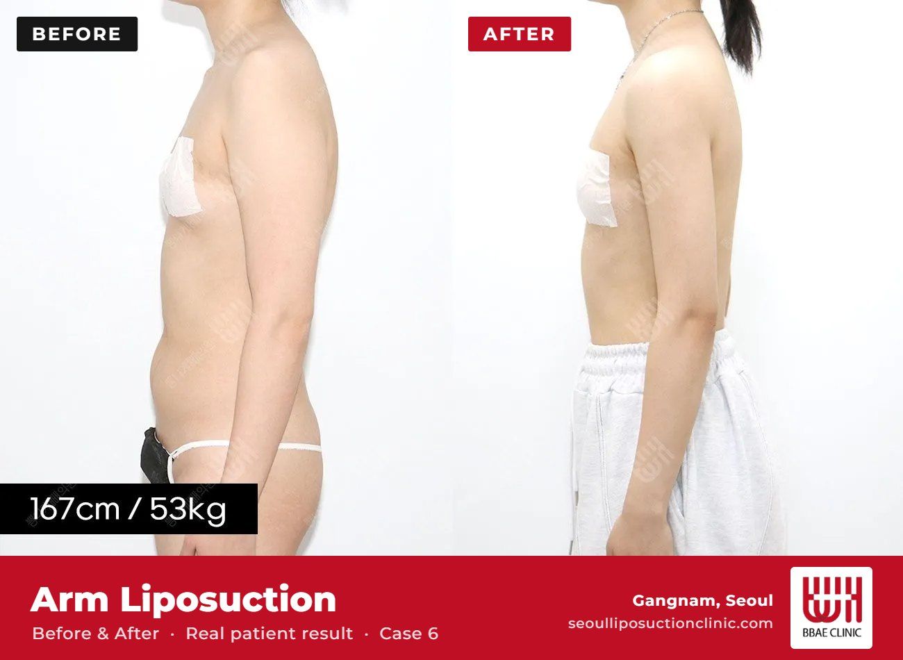 Arm liposuction before and after, case 6 (photo 1 of 2) – BBAE Clinic, Gangnam Seoul