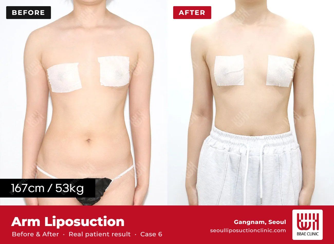 Arm liposuction before and after, case 6 (photo 2 of 2) – BBAE Clinic, Gangnam Seoul