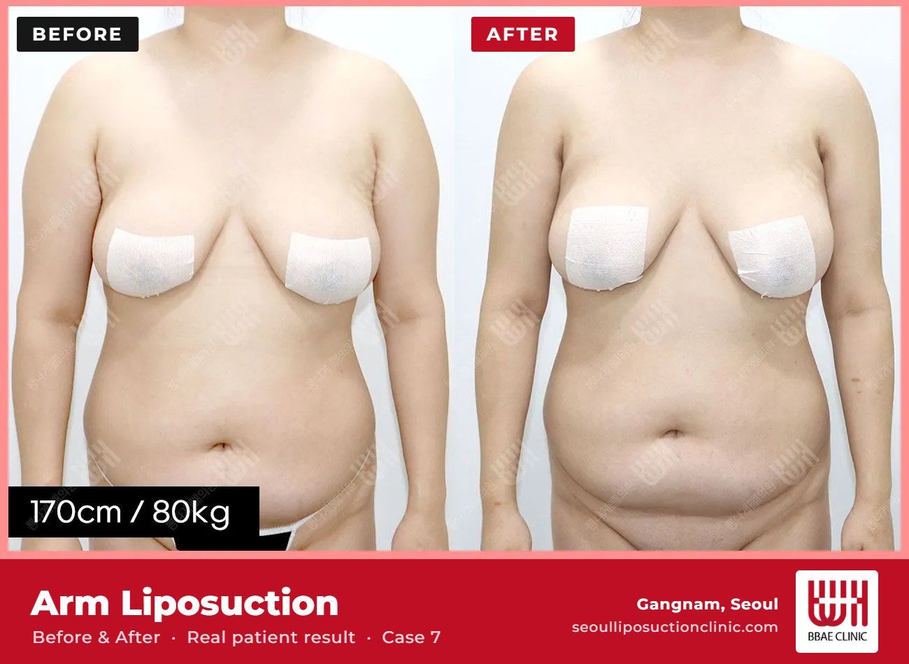 Arm liposuction before and after, case 7 (photo 1 of 2) – BBAE Clinic, Gangnam Seoul