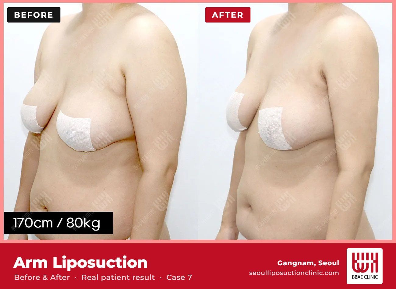 Arm liposuction before and after, case 7 (photo 2 of 2) – BBAE Clinic, Gangnam Seoul
