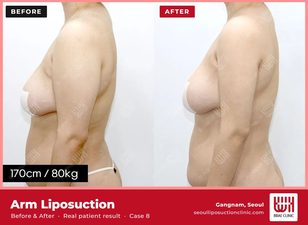 Arm liposuction before and after, case 8 (photo 1 of 2) – BBAE Clinic, Gangnam Seoul