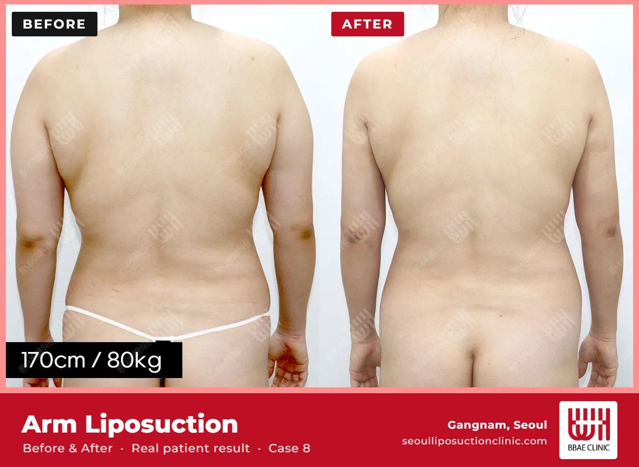 Arm liposuction before and after, case 8 (photo 2 of 2) – BBAE Clinic, Gangnam Seoul