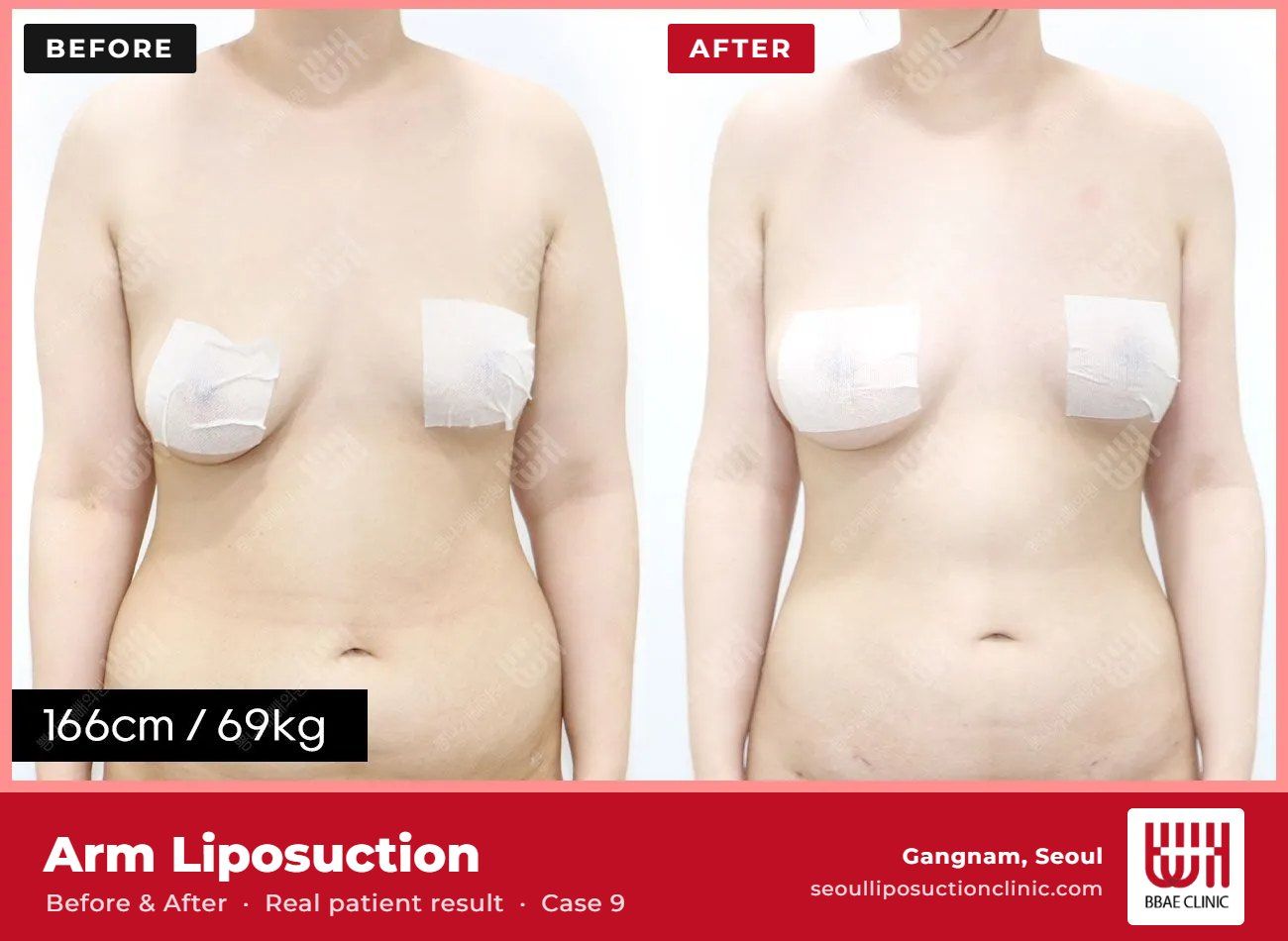 Arm liposuction before and after, case 9 (photo 1 of 2) – BBAE Clinic, Gangnam Seoul