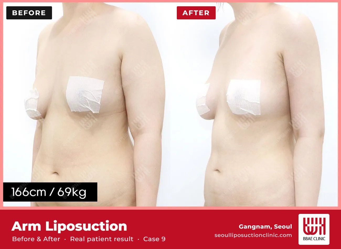 Arm liposuction before and after, case 9 (photo 2 of 2) – BBAE Clinic, Gangnam Seoul