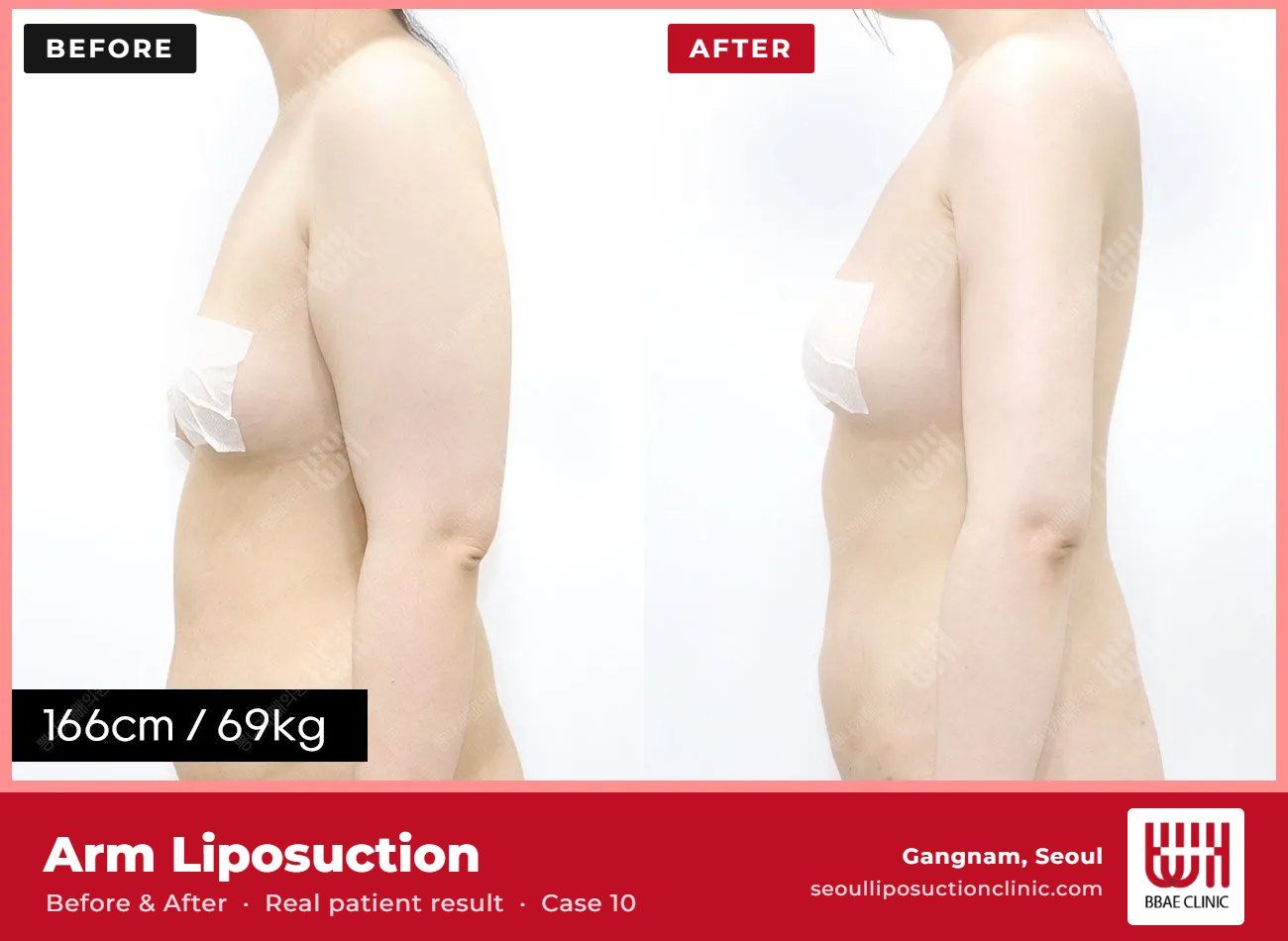 Arm liposuction before and after, case 10 (photo 1 of 2) – BBAE Clinic, Gangnam Seoul