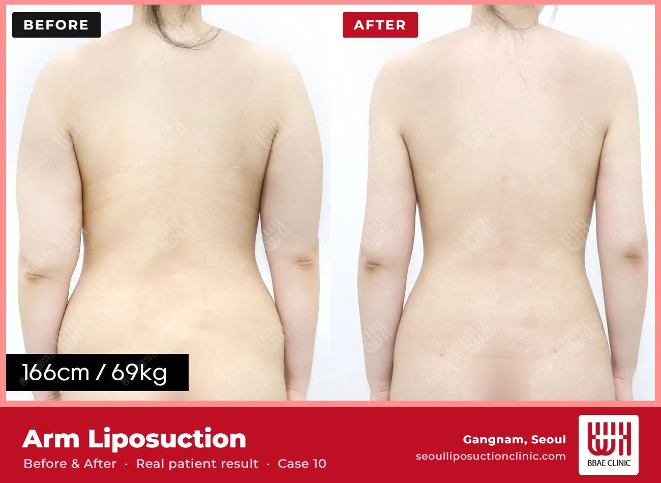 Arm liposuction before and after, case 10 (photo 2 of 2) – BBAE Clinic, Gangnam Seoul
