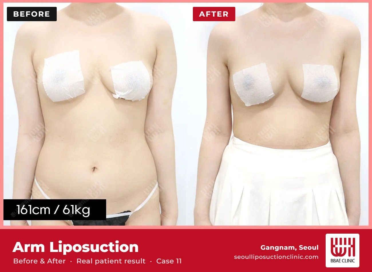 Arm liposuction before and after, case 11 (photo 1 of 2) – BBAE Clinic, Gangnam Seoul