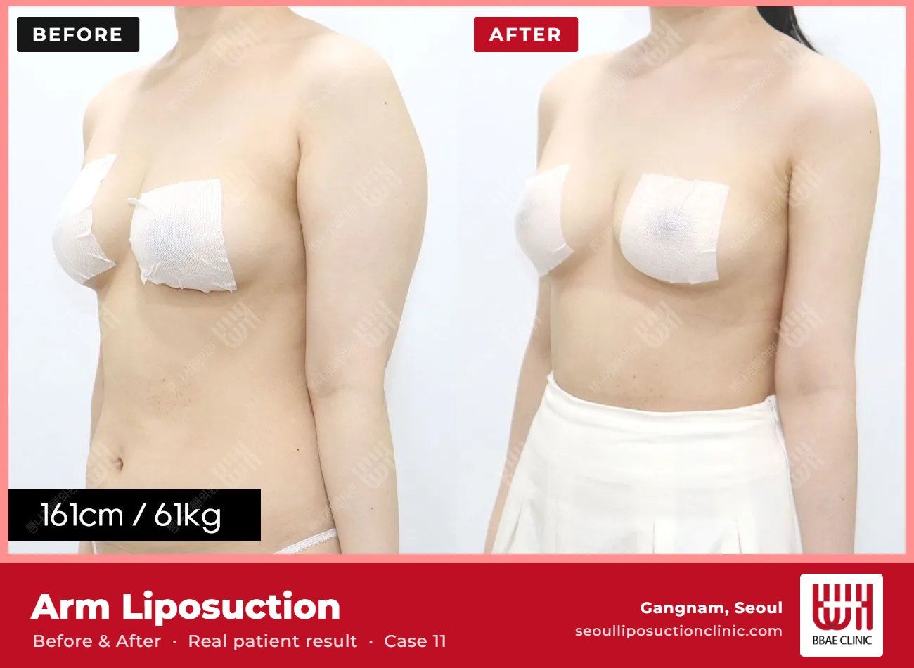 Arm liposuction before and after, case 11 (photo 2 of 2) – BBAE Clinic, Gangnam Seoul