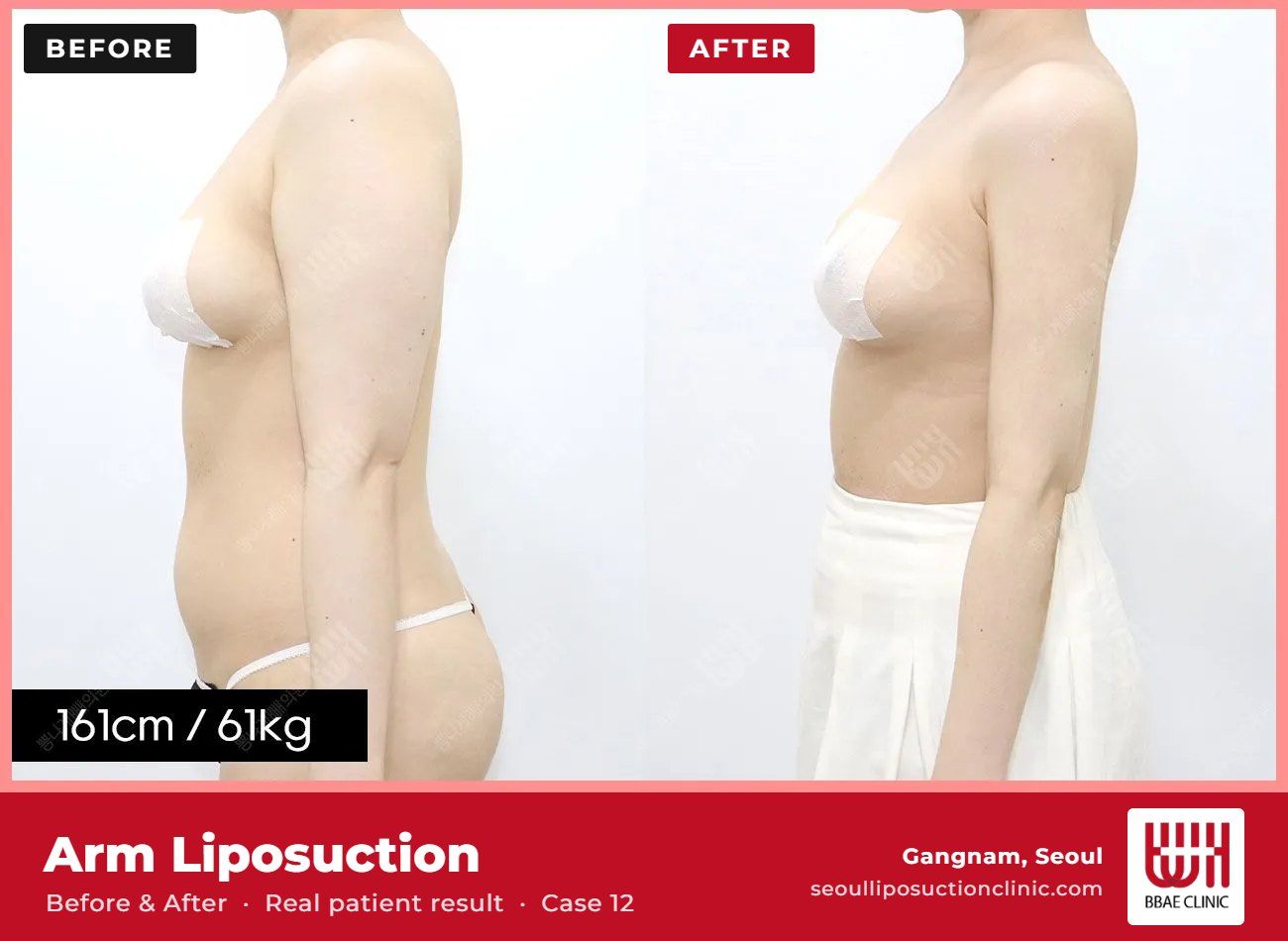 Arm liposuction before and after, case 12 (photo 1 of 2) – BBAE Clinic, Gangnam Seoul